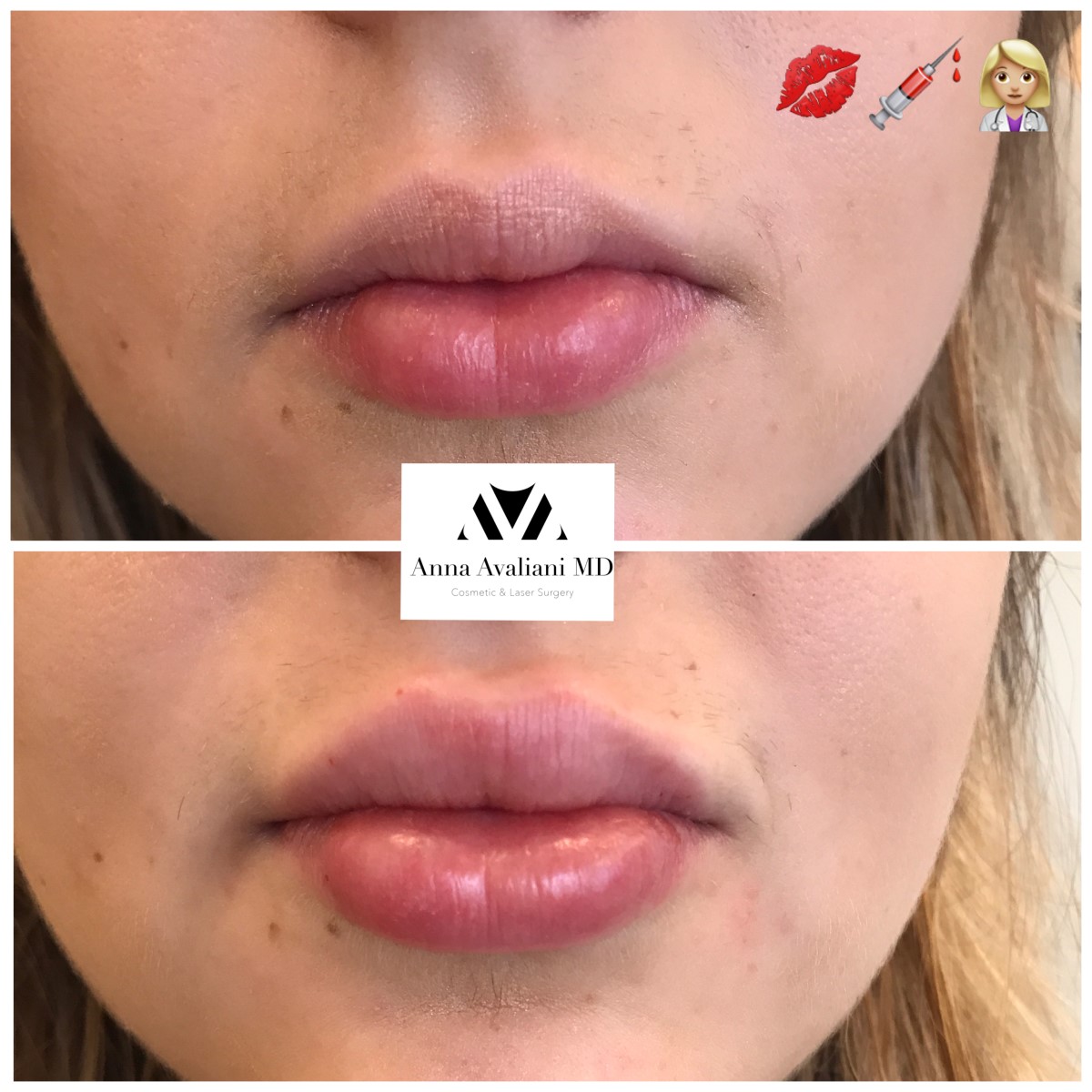 Lip Augmentation after — Dr. Anna Avaliani
