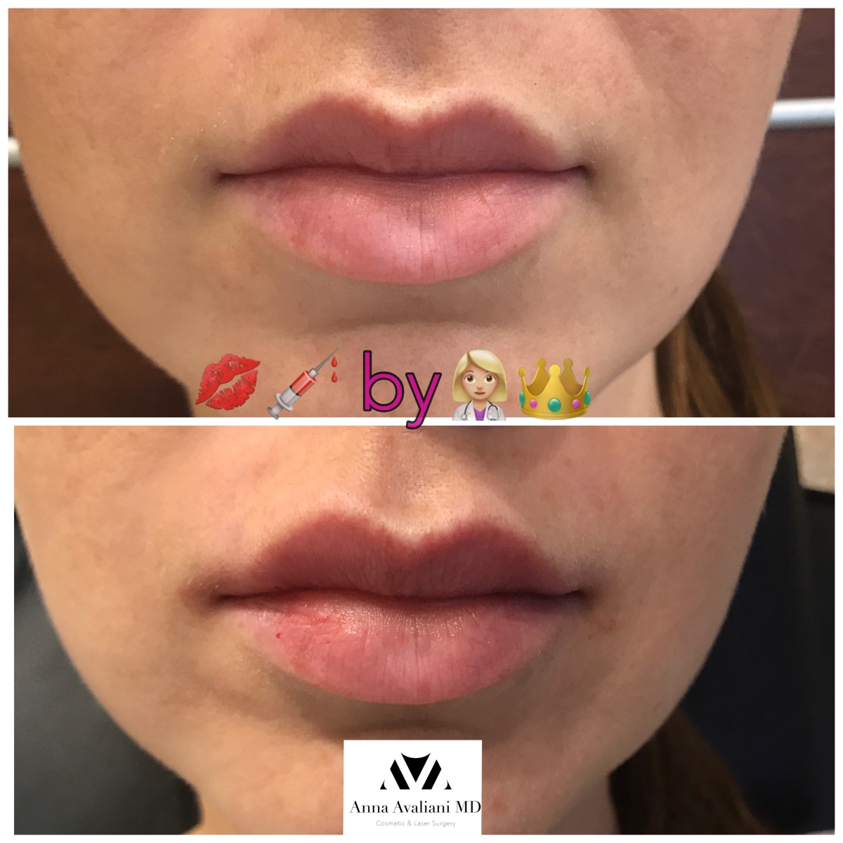 Lip Augmentation before — Dr. Anna Avaliani