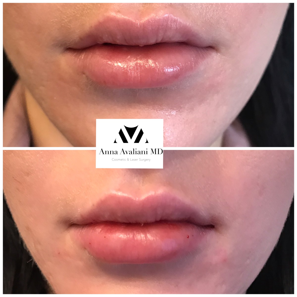 Lip Augmentation after — Dr. Anna Avaliani