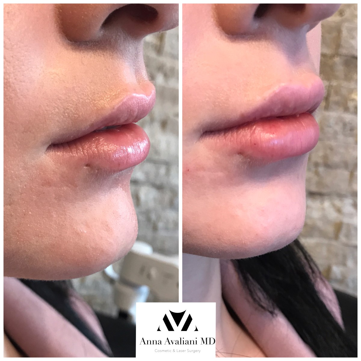Lip Augmentation before — Dr. Anna Avaliani