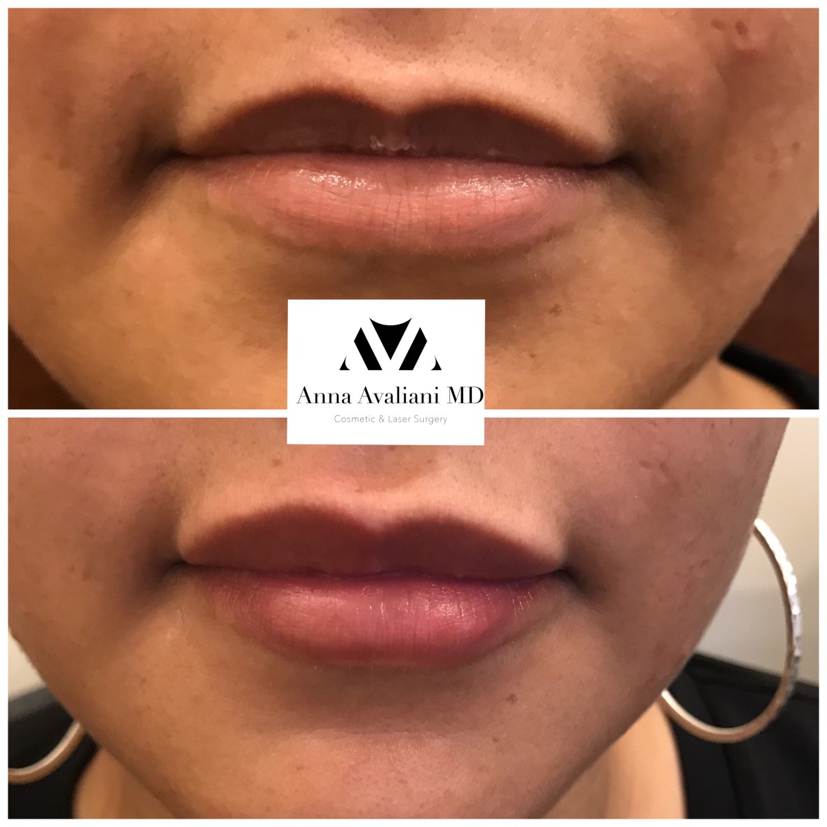 Lip Augmentation after — Dr. Anna Avaliani