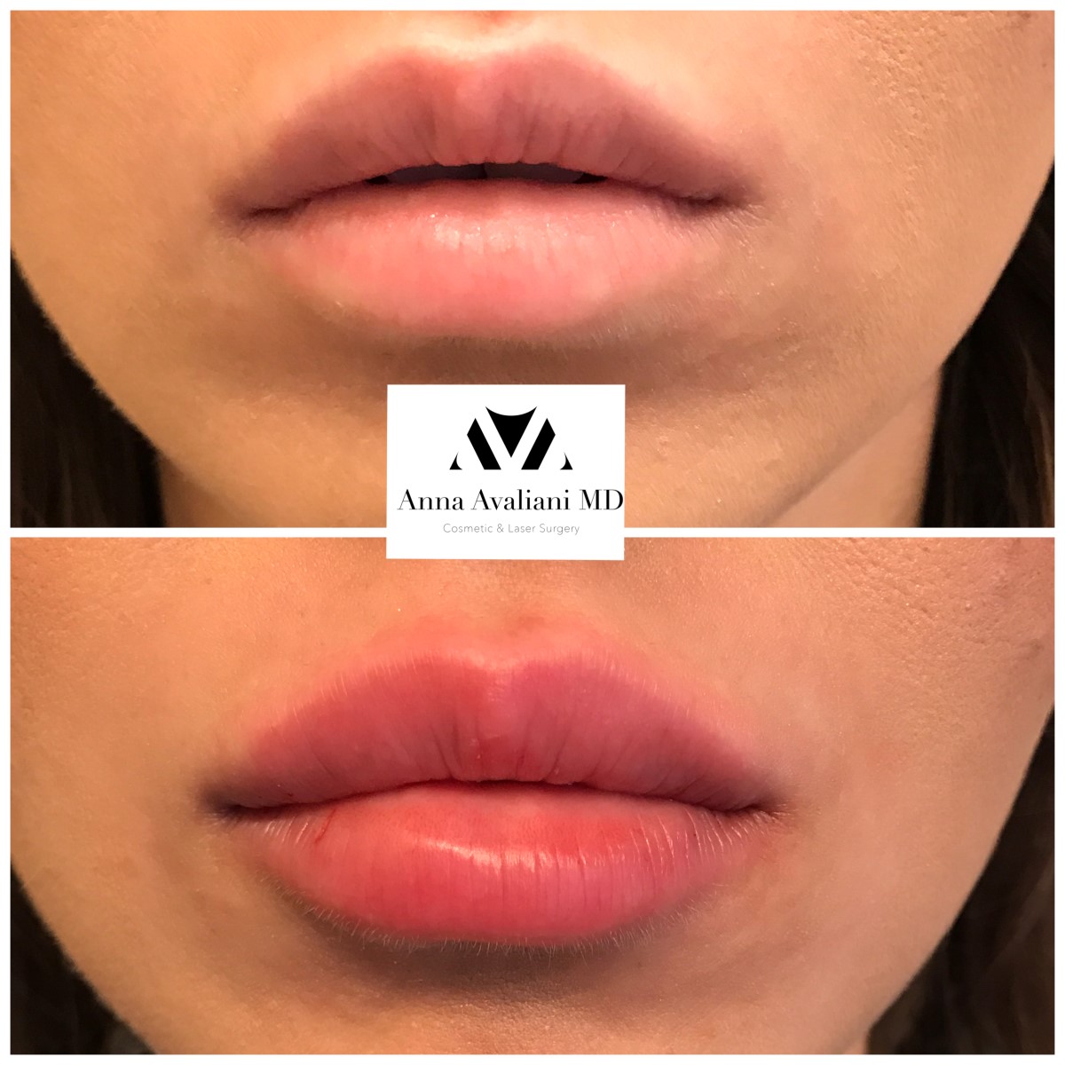 Lip Augmentation before — Dr. Anna Avaliani