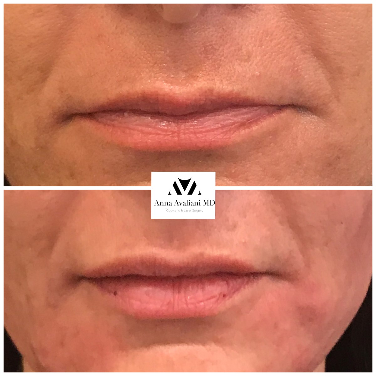 Lip Augmentation after — Dr. Anna Avaliani