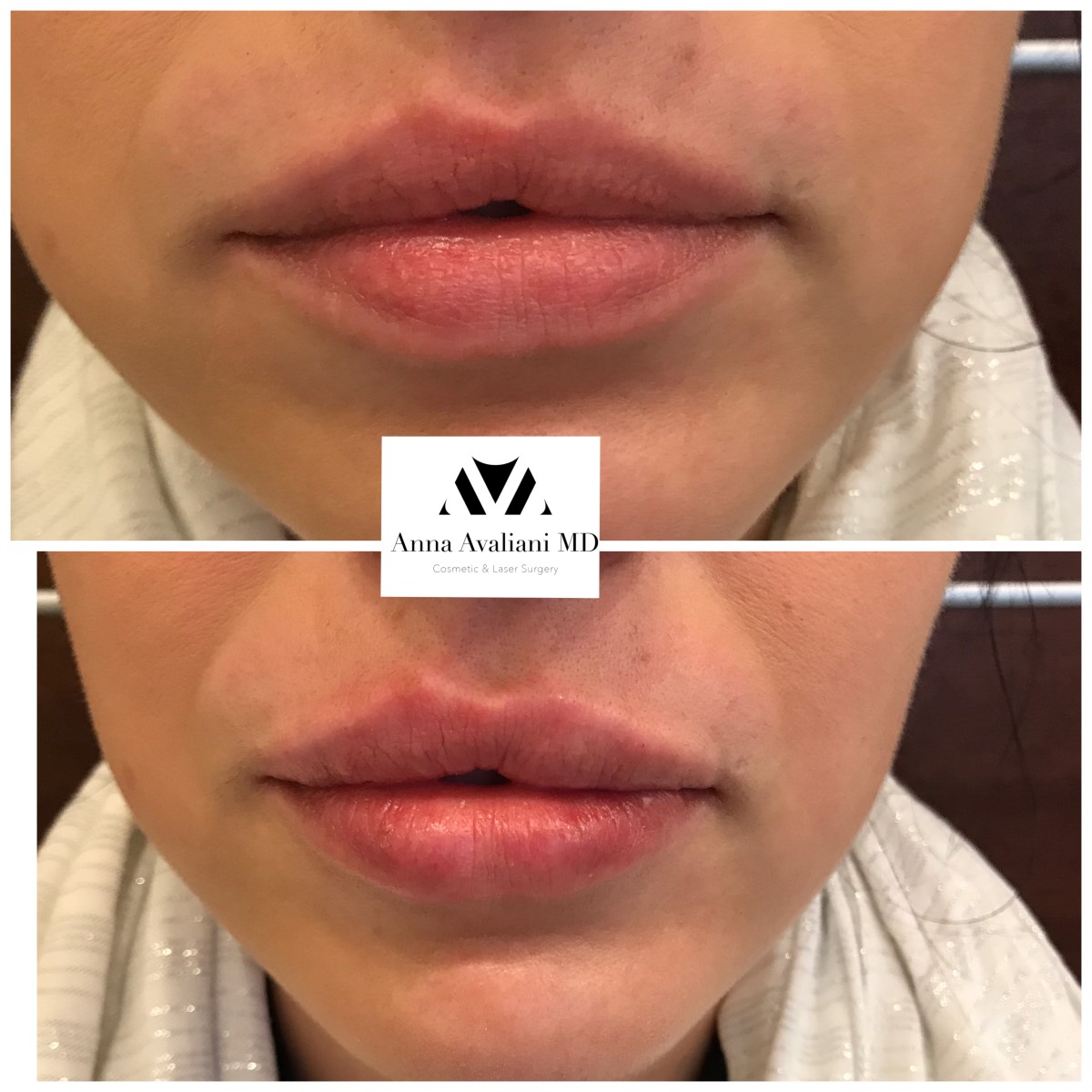 Lip Augmentation before — Dr. Anna Avaliani
