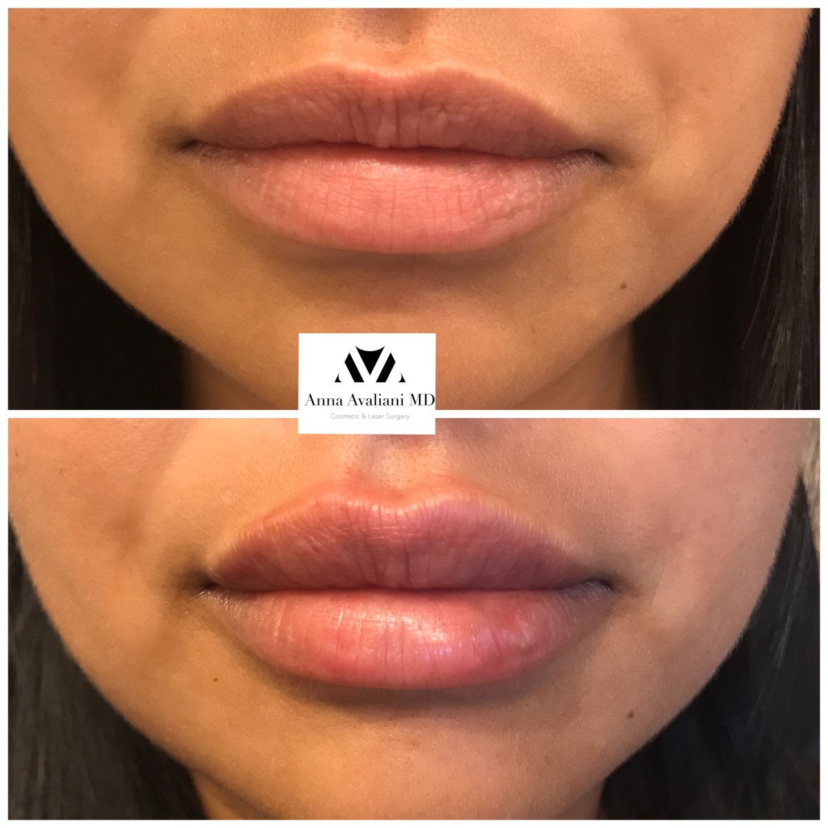 Lip Augmentation after — Dr. Anna Avaliani