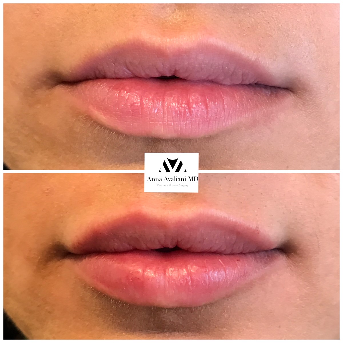 Lip Augmentation before — Dr. Anna Avaliani