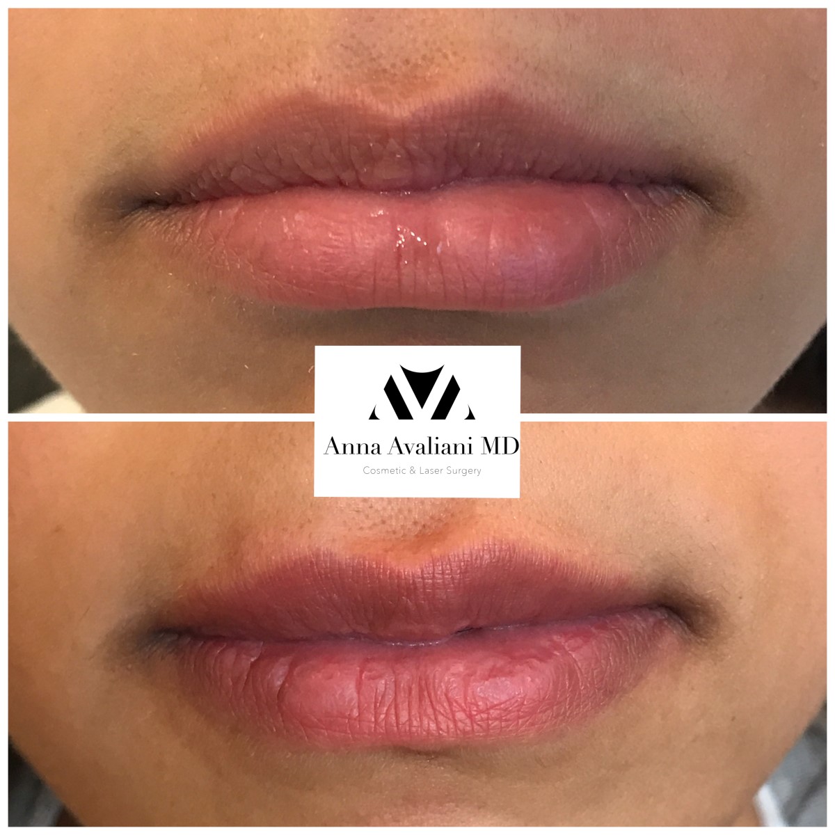 Lip Augmentation after — Dr. Anna Avaliani