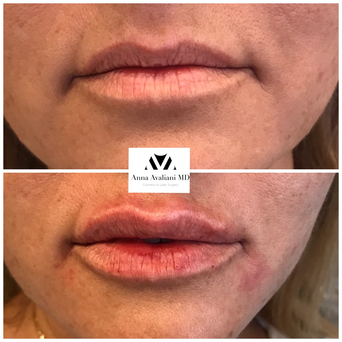 Lip Augmentation before — Dr. Anna Avaliani