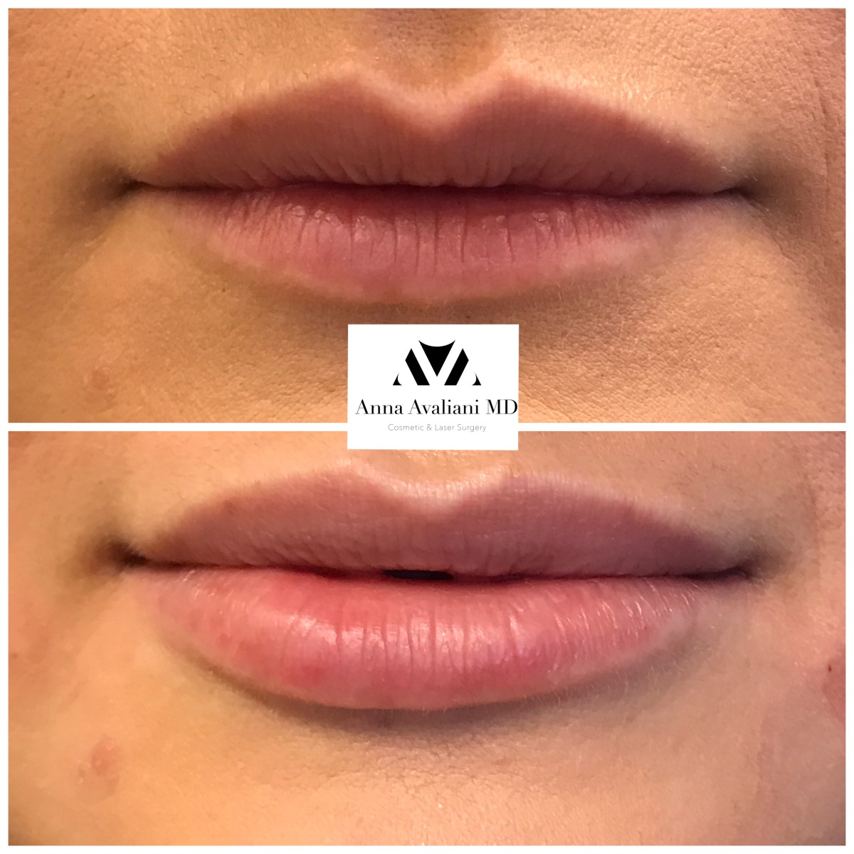 Lip Augmentation after — Dr. Anna Avaliani