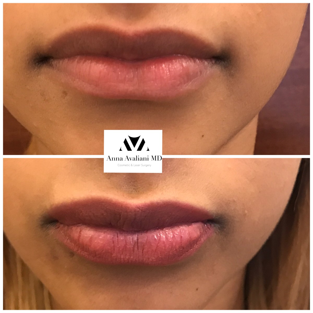 Lip Augmentation before — Dr. Anna Avaliani
