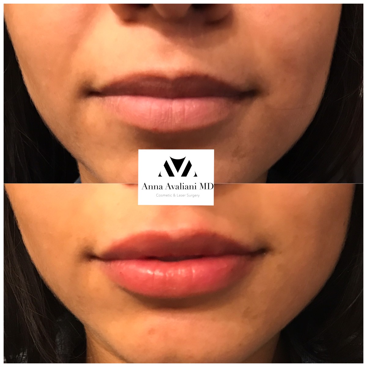 Lip Augmentation after — Dr. Anna Avaliani