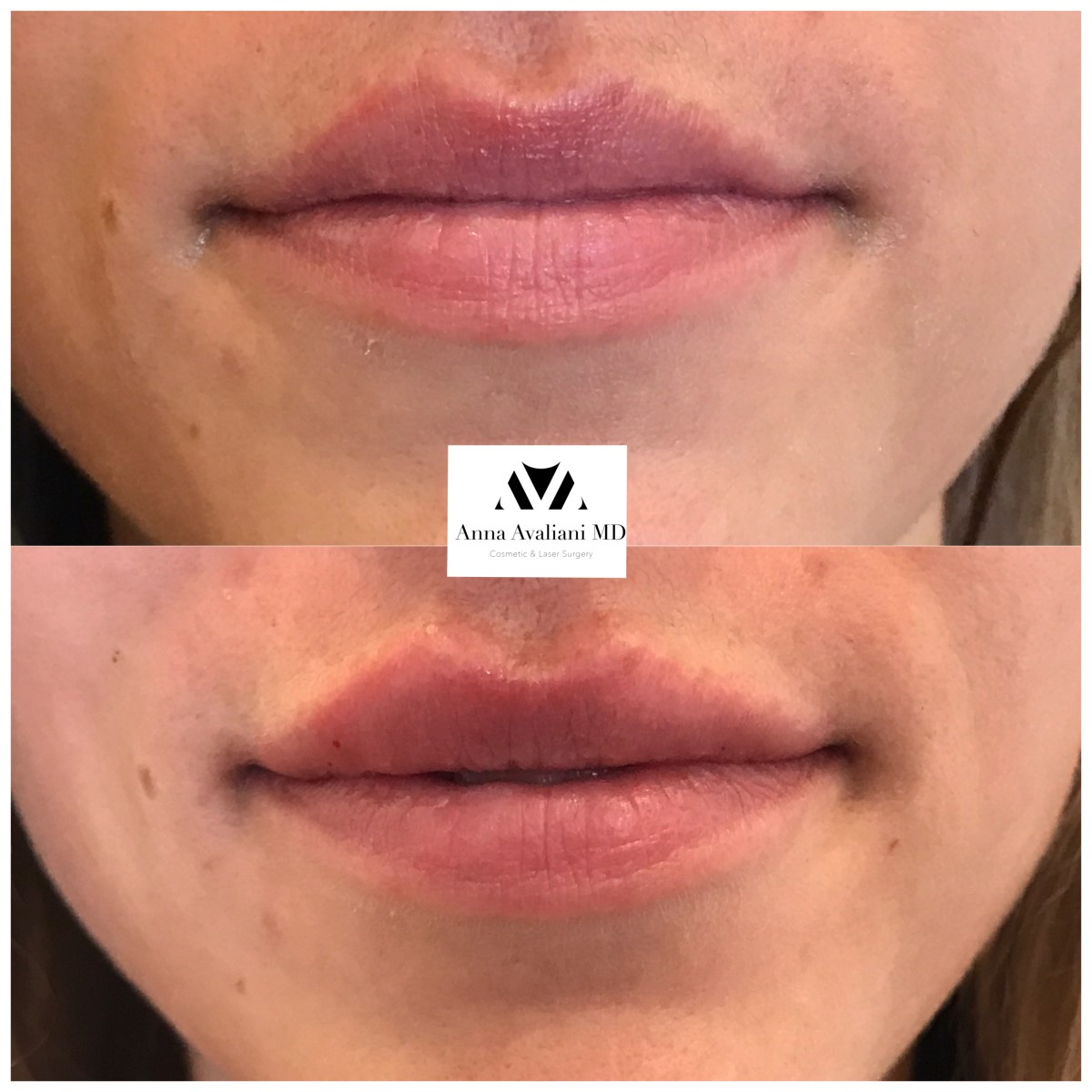 Lip Augmentation before — Dr. Anna Avaliani
