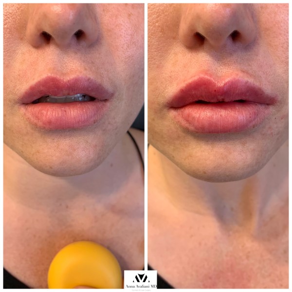 Lip Augmentation after — Dr. Anna Avaliani