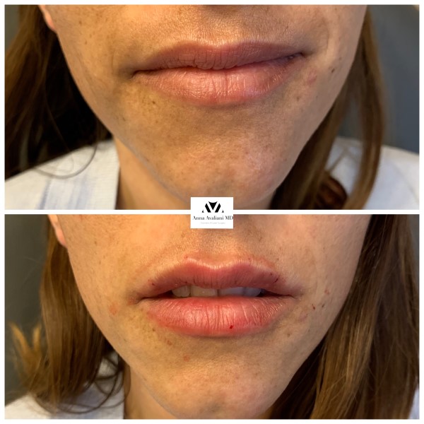 Lip Augmentation before — Dr. Anna Avaliani