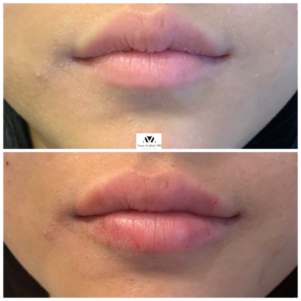 Lip Augmentation after — Dr. Anna Avaliani