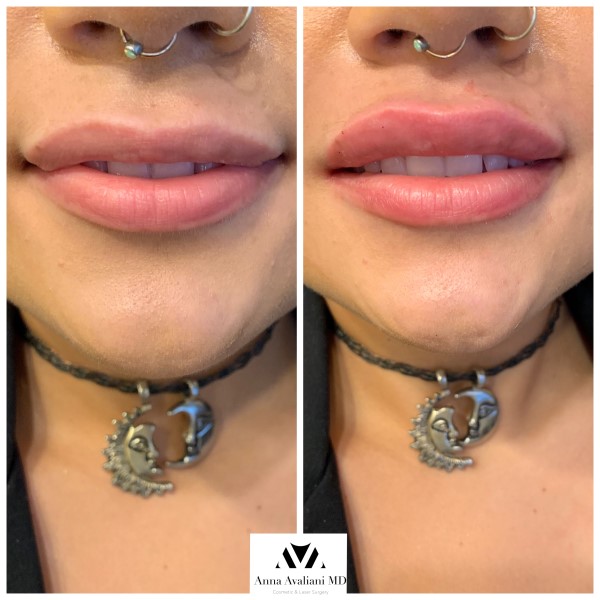 Lip Augmentation before — Dr. Anna Avaliani
