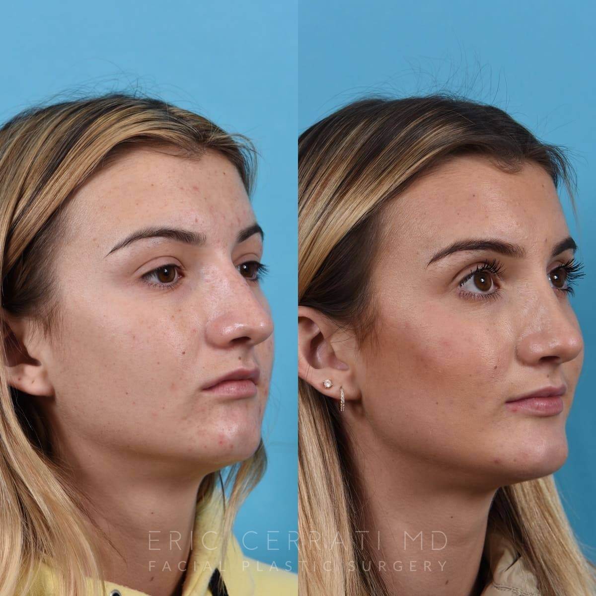 Rhinoplasty + Chin Implant before and after - after