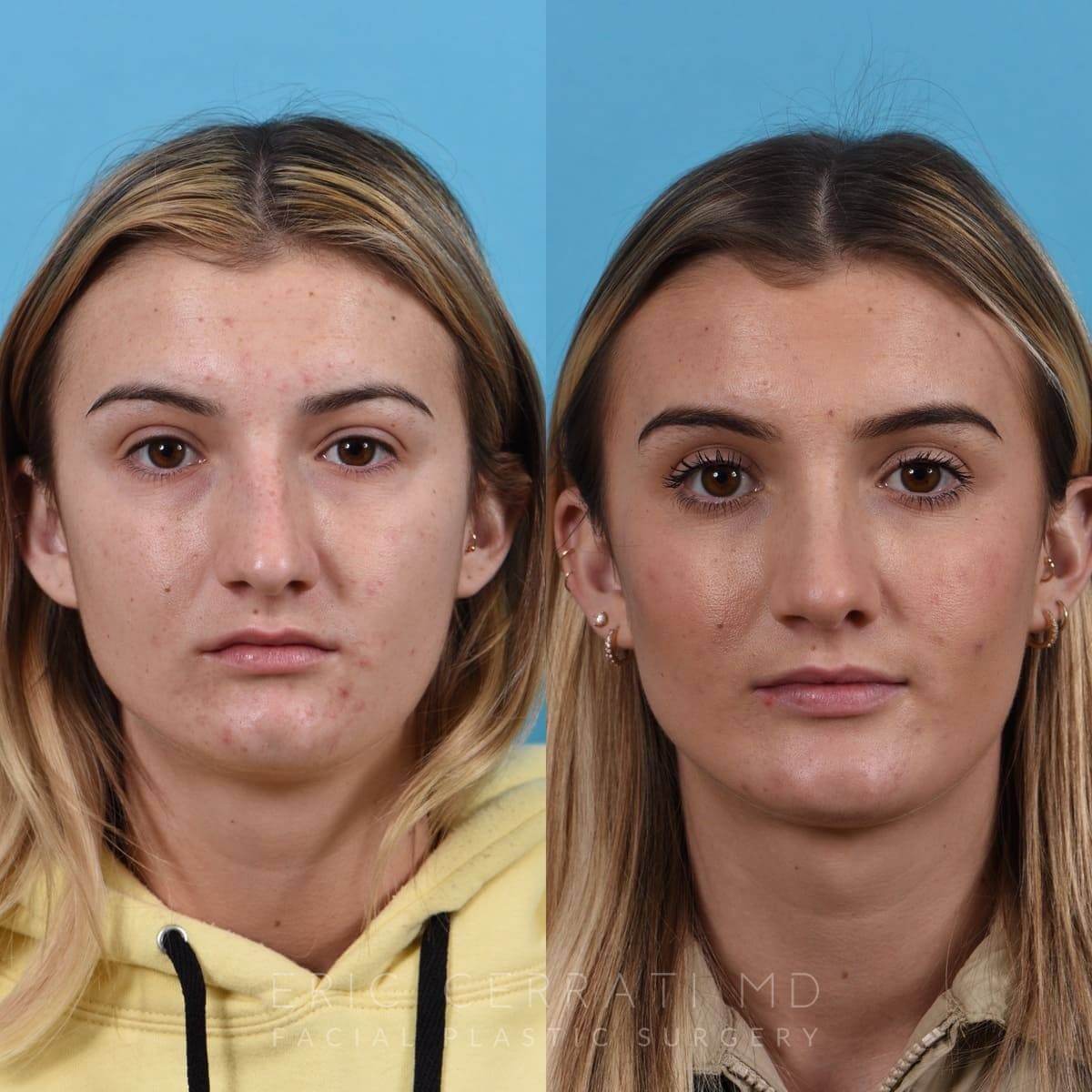 Rhinoplasty + Chin Implant before and after - before