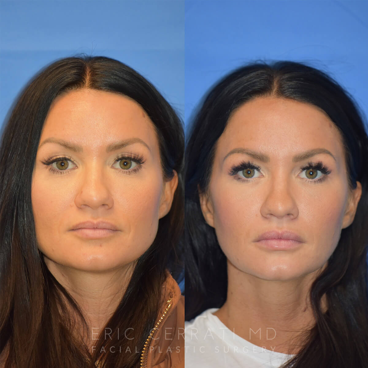 Masseter Botox before and after - before