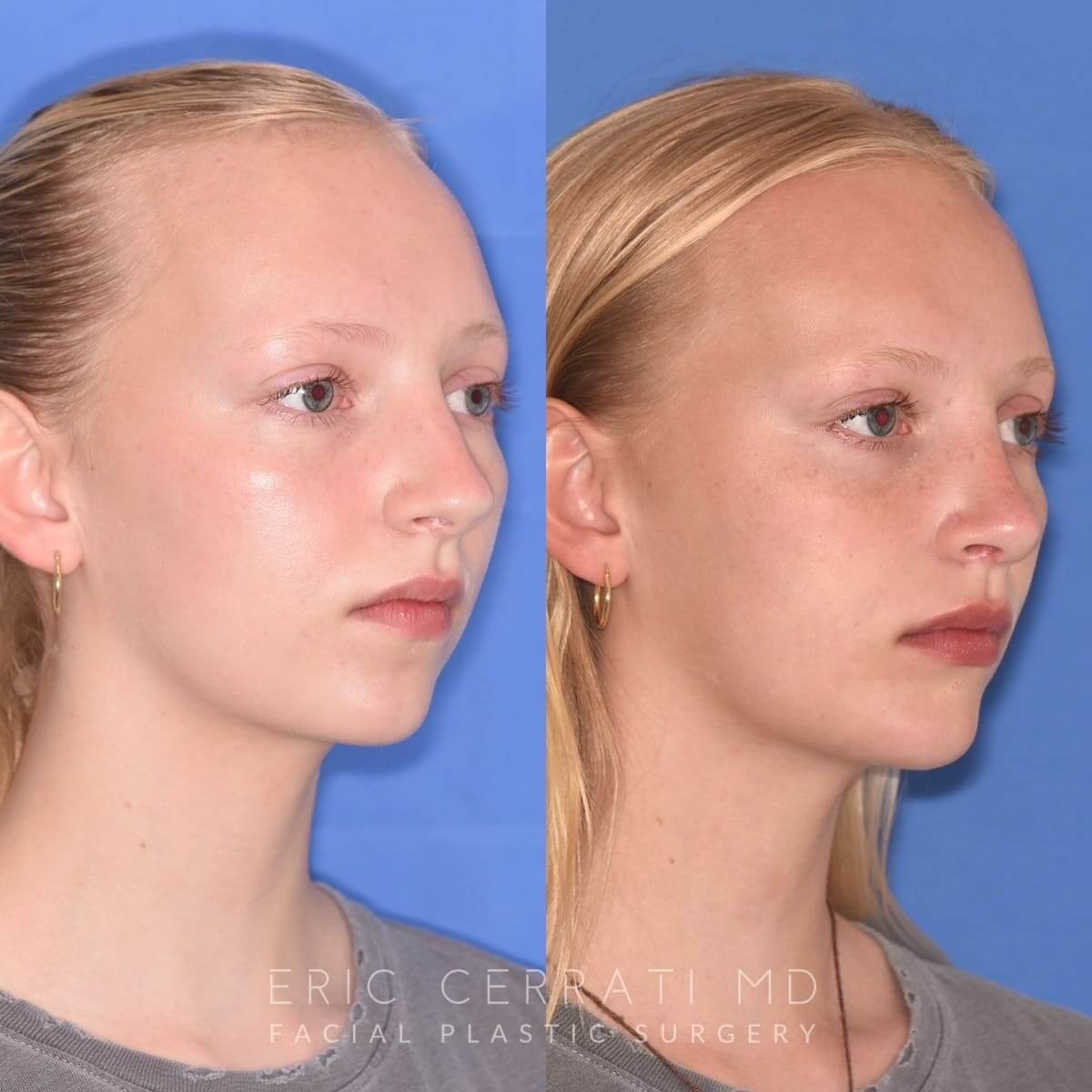 Rhinoplasty before and after - after