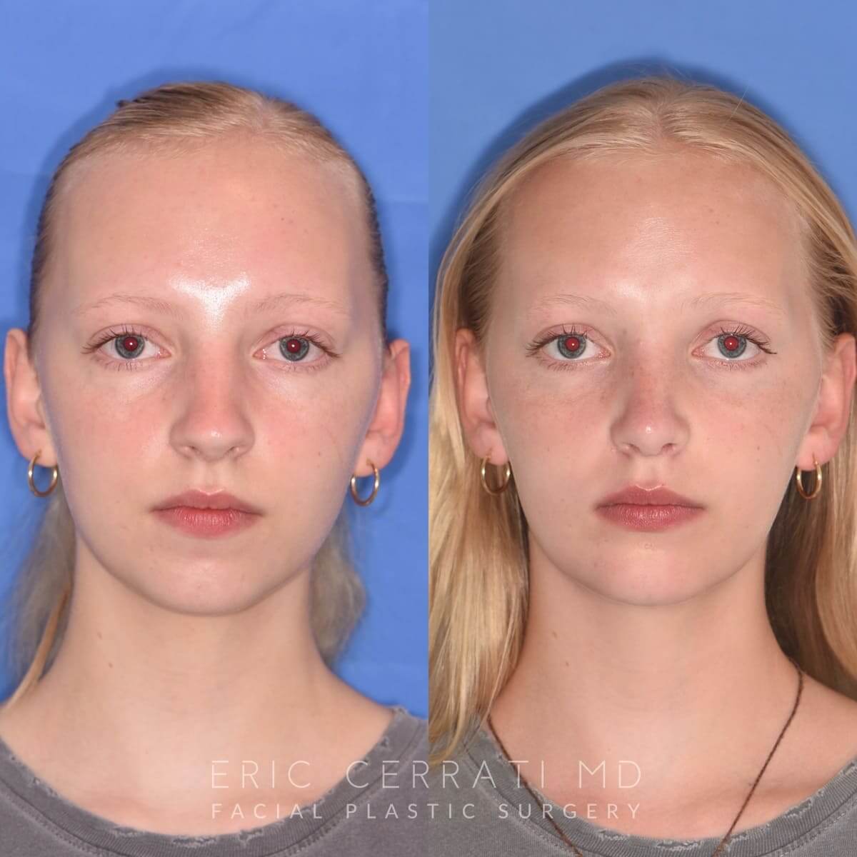 Rhinoplasty before and after - before