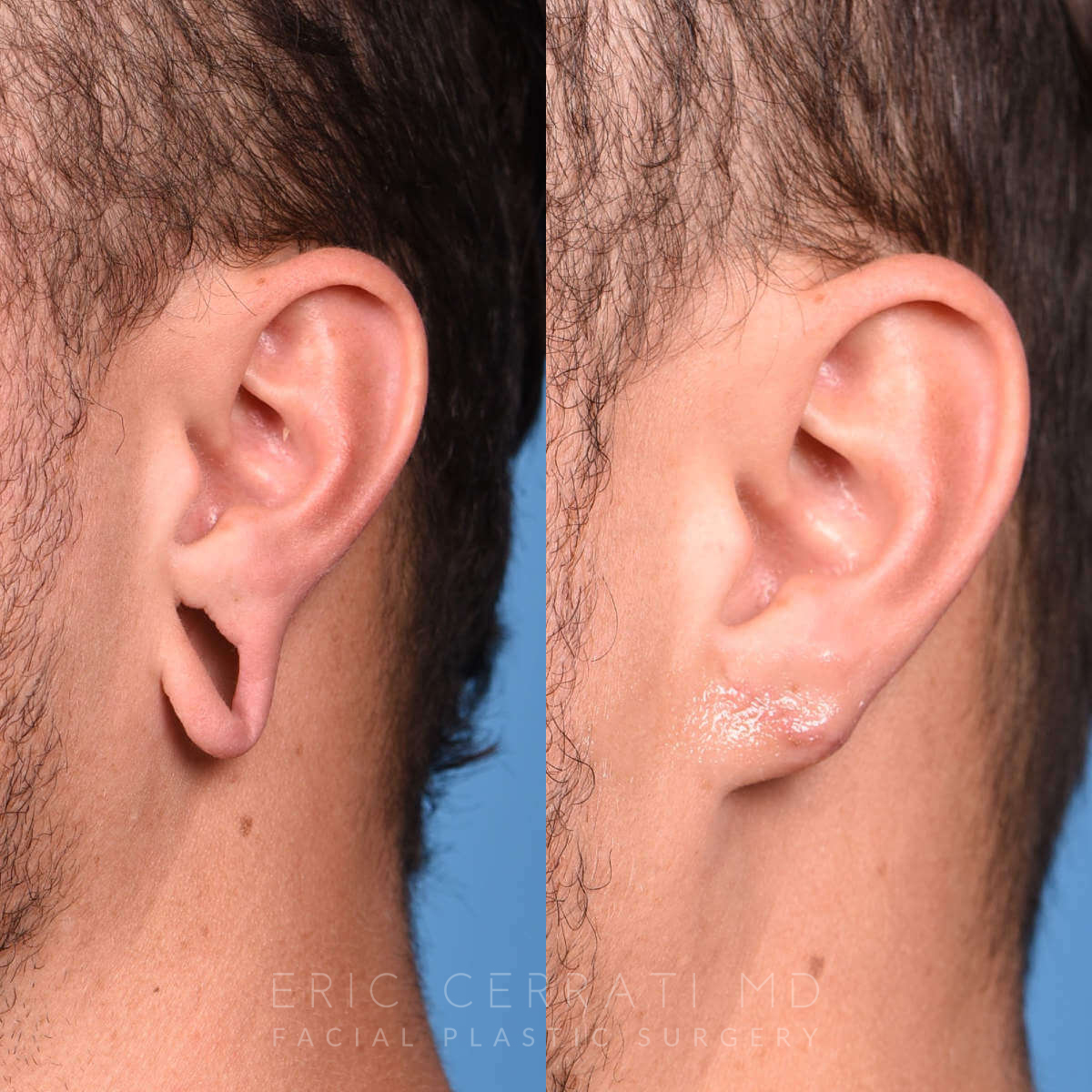 Earlobe Repair before and after - after