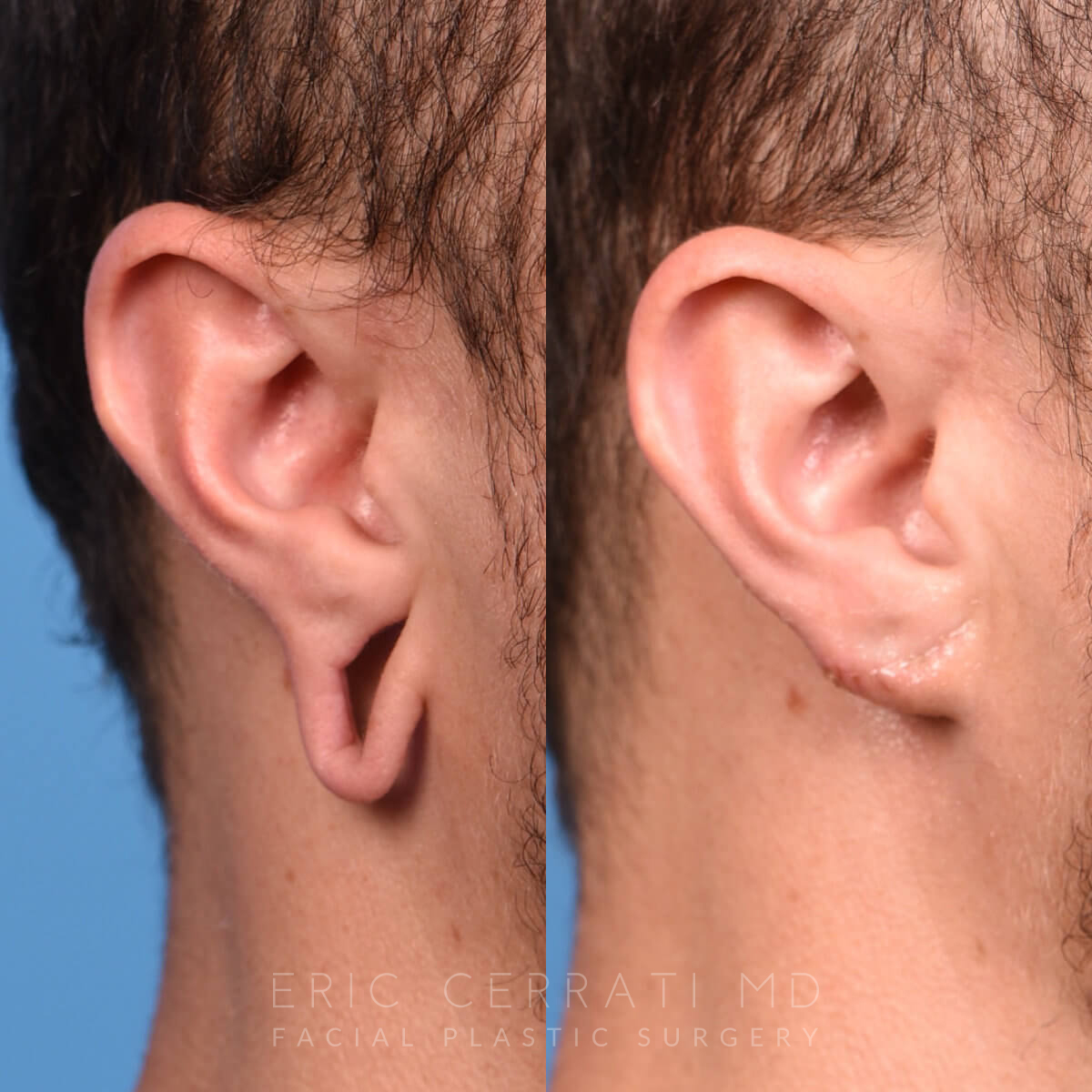 Earlobe Repair before and after - before
