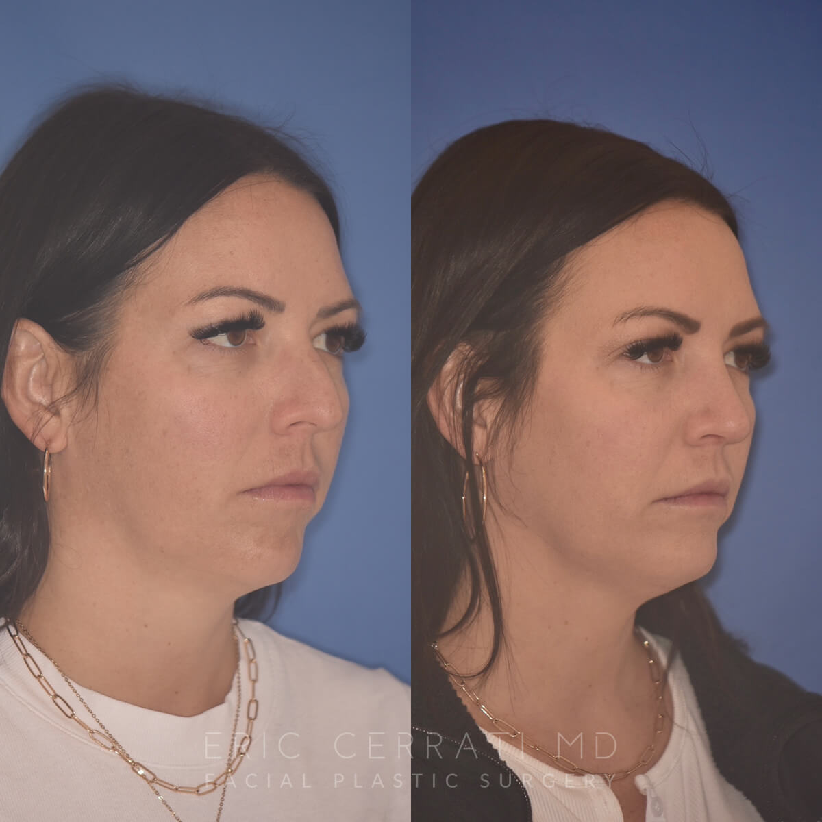 Rhinoplasty + Chin Implant before and after - after
