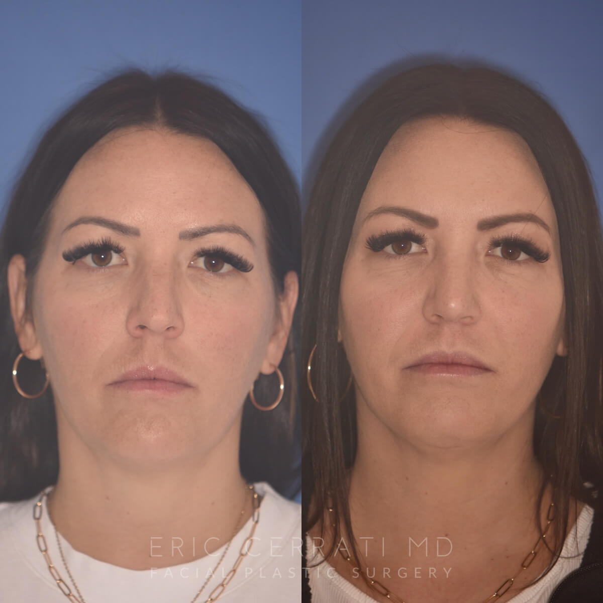 Rhinoplasty + Chin Implant before and after - before