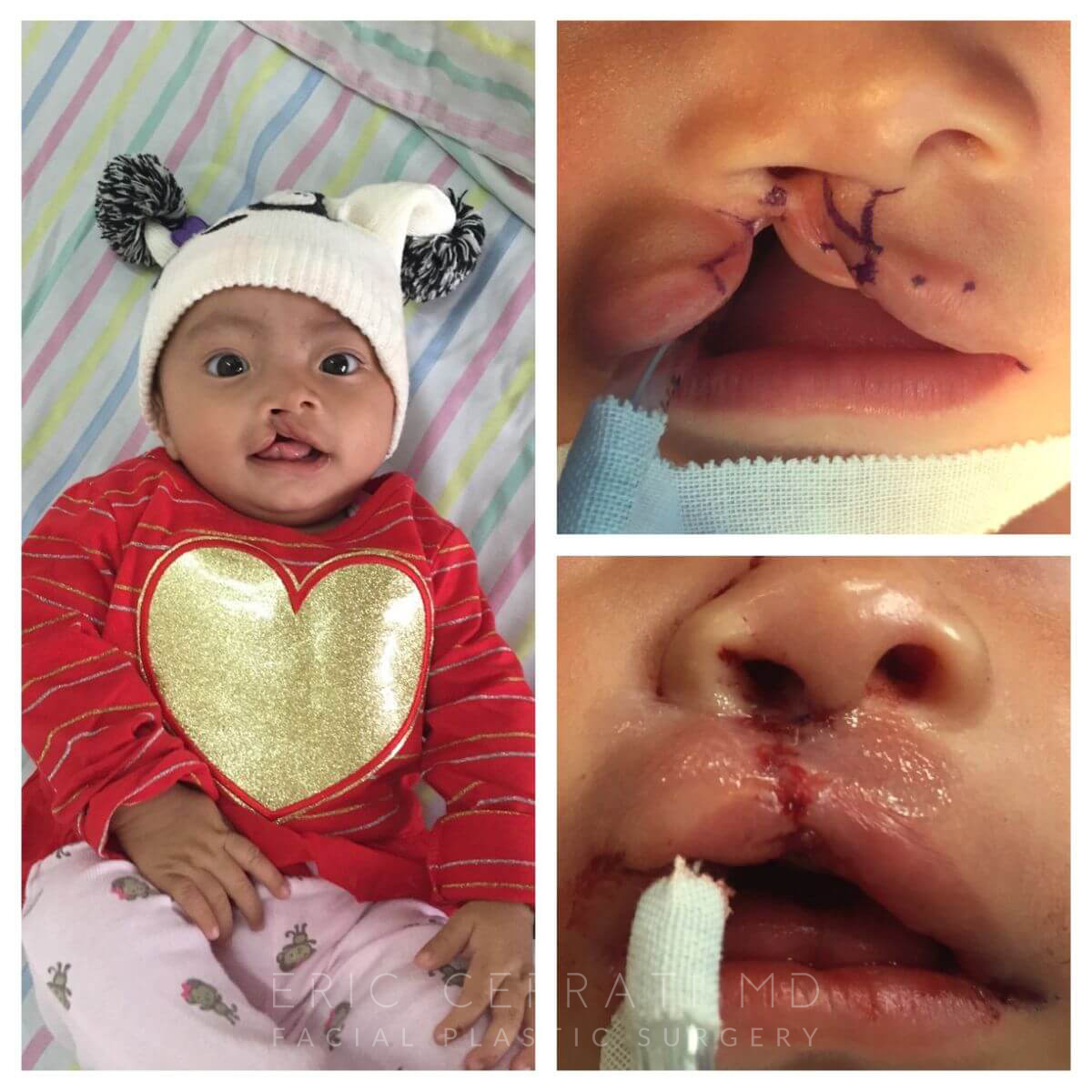 Cleft Lip and Palate Repair before and after - before