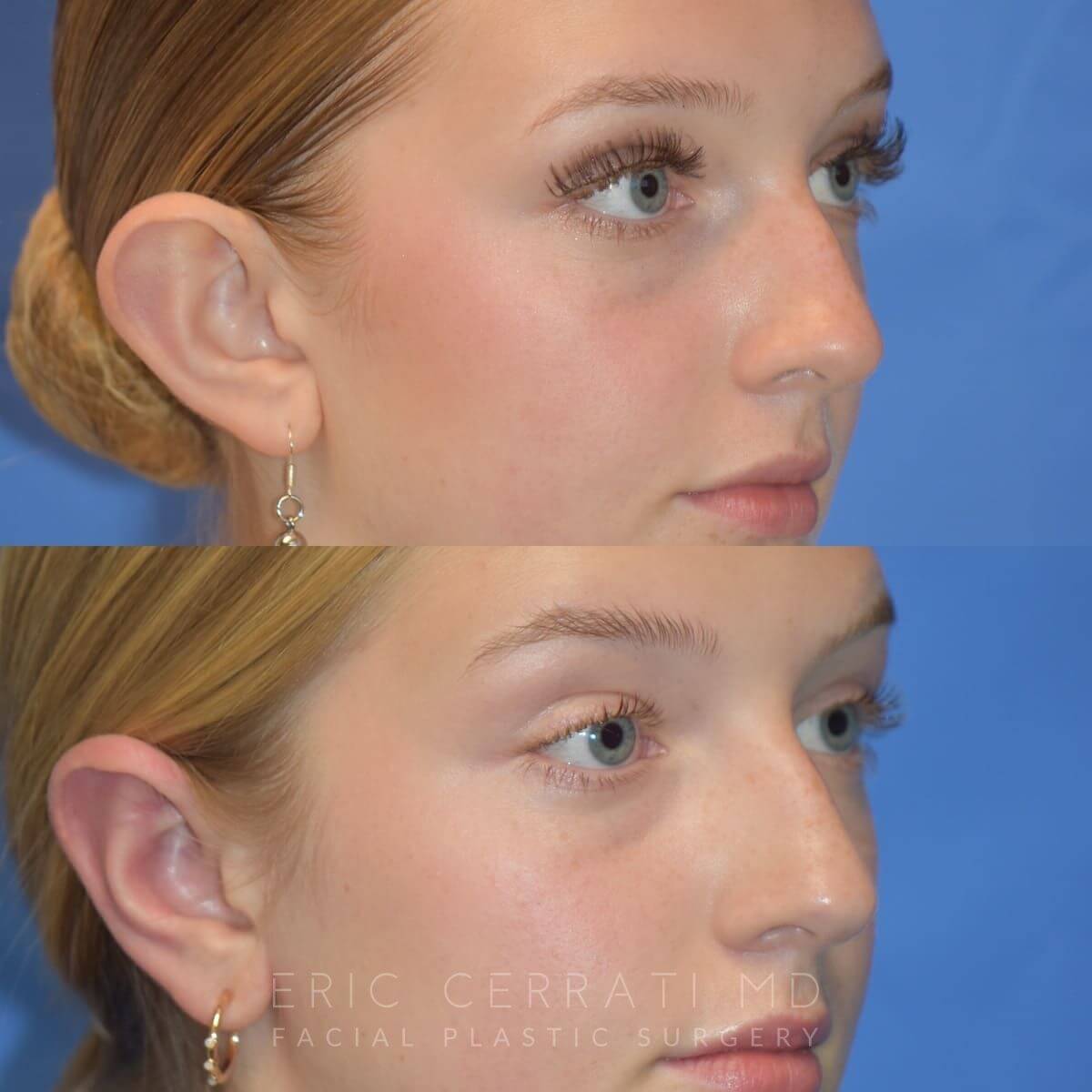Ear Gauged Repair before and after - after