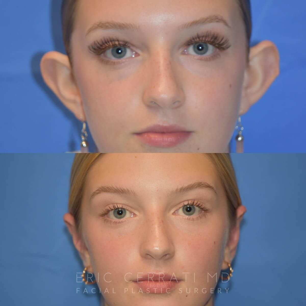 Ear Gauged Repair before and after - before