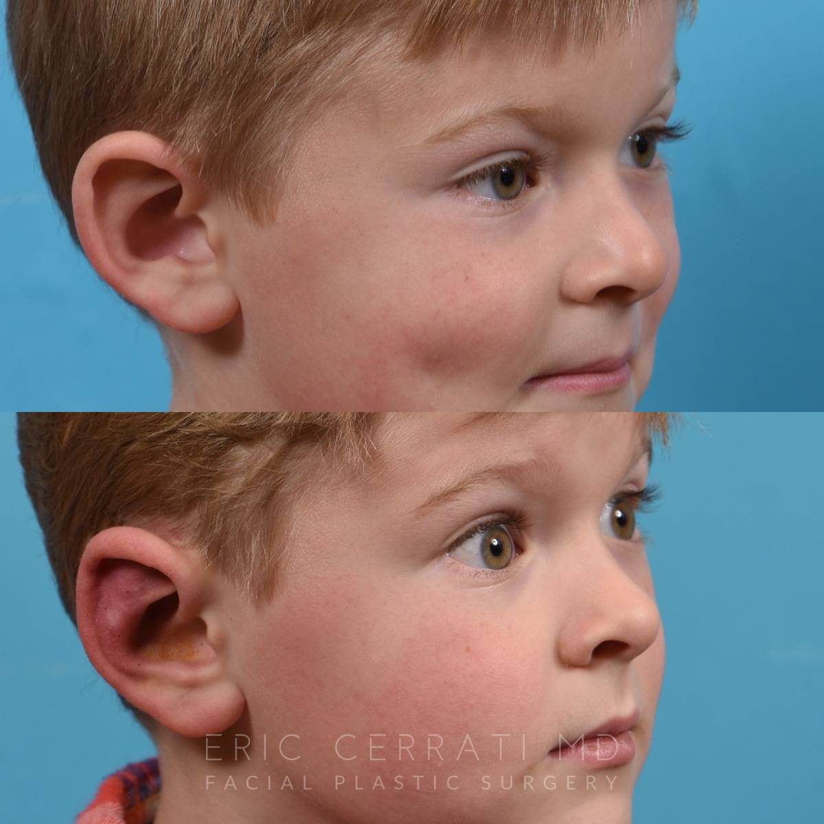 Bilateral Otoplasty before and after - after