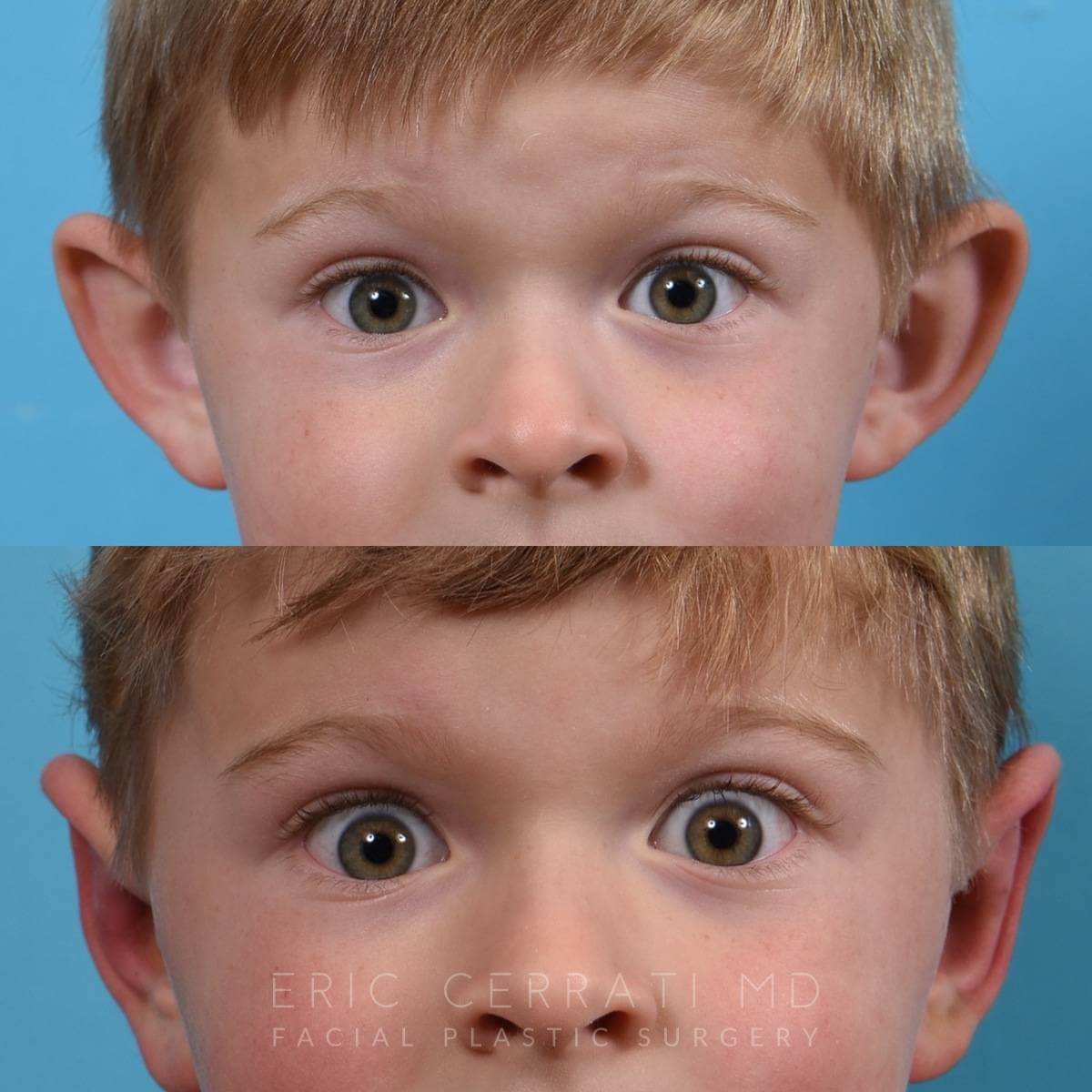 Bilateral Otoplasty before and after - before