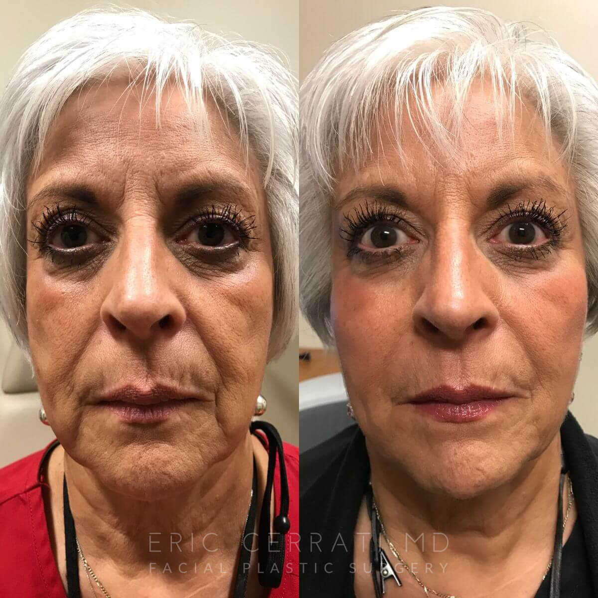 Facial Injectable Treatment before and after - after