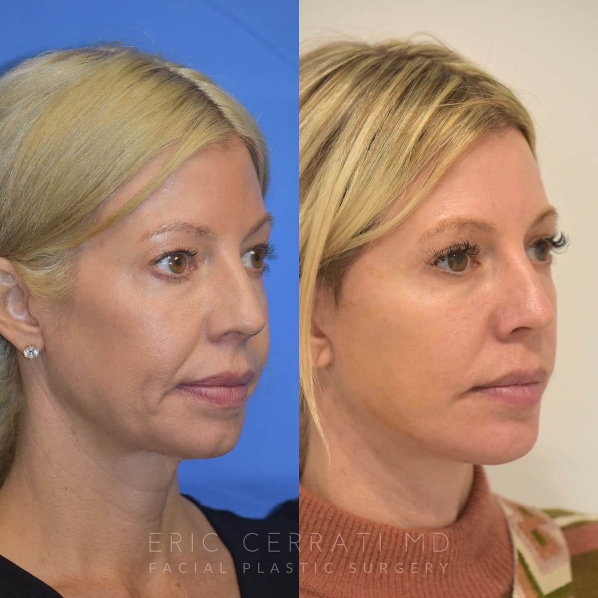 Chin Implant before and after - after