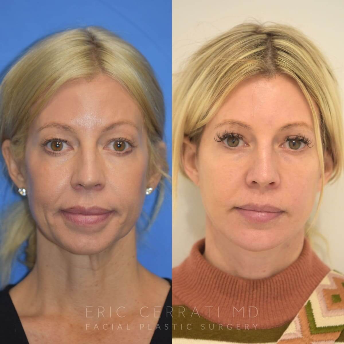 Chin Implant before and after - before