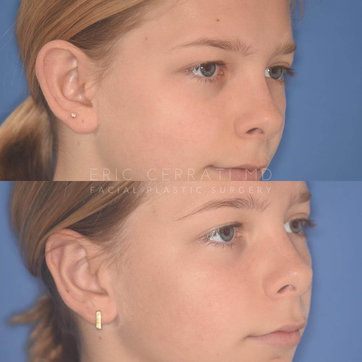 Otoplasty before and after - after