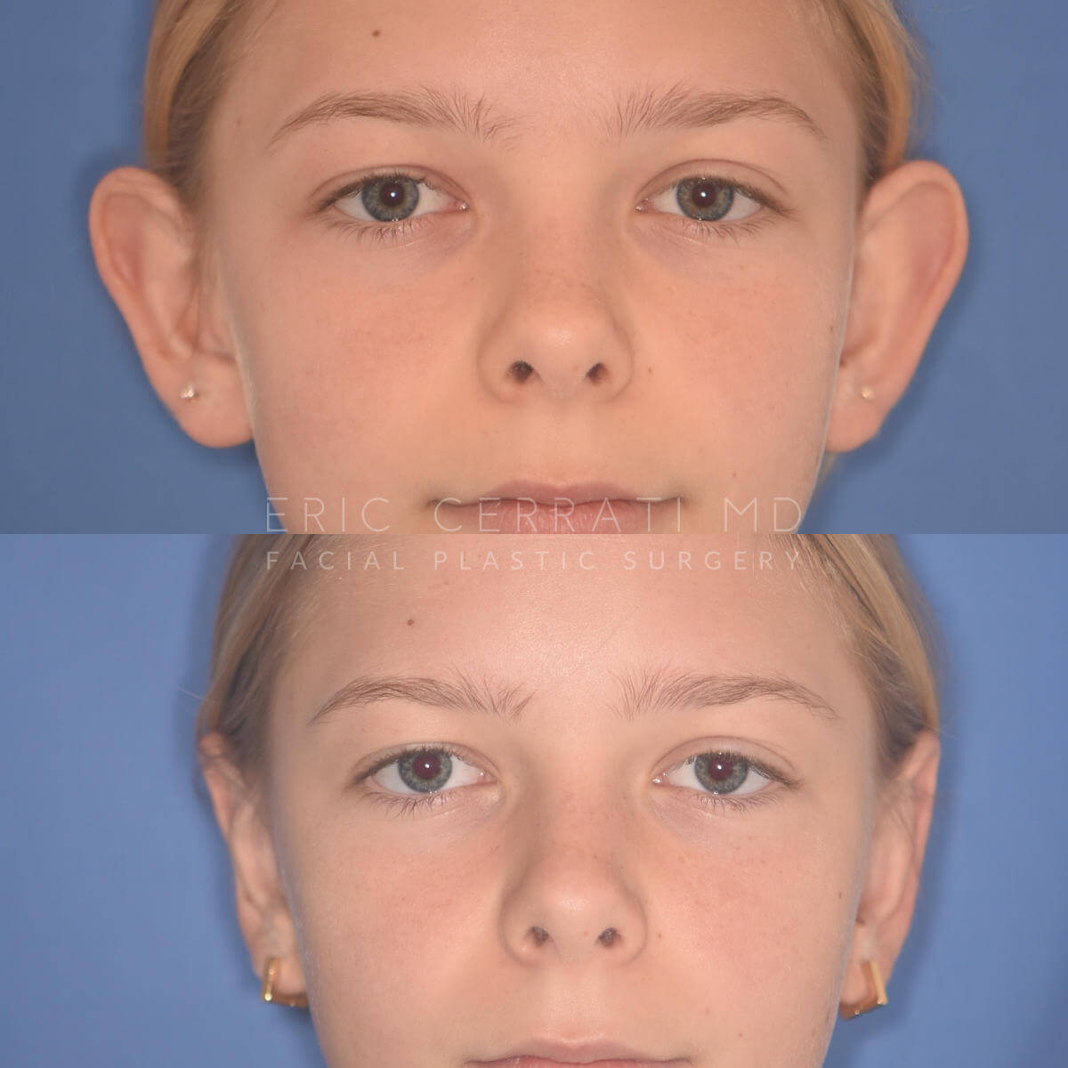 Otoplasty before and after - before
