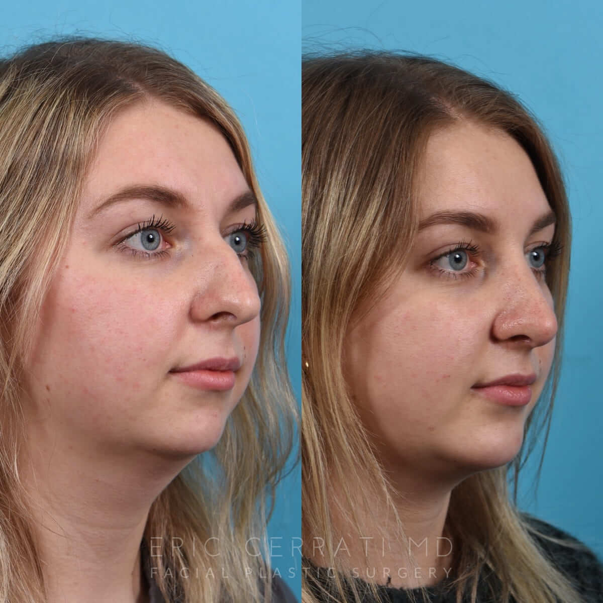 Rhinoplasty + Chin Implant before and after - after