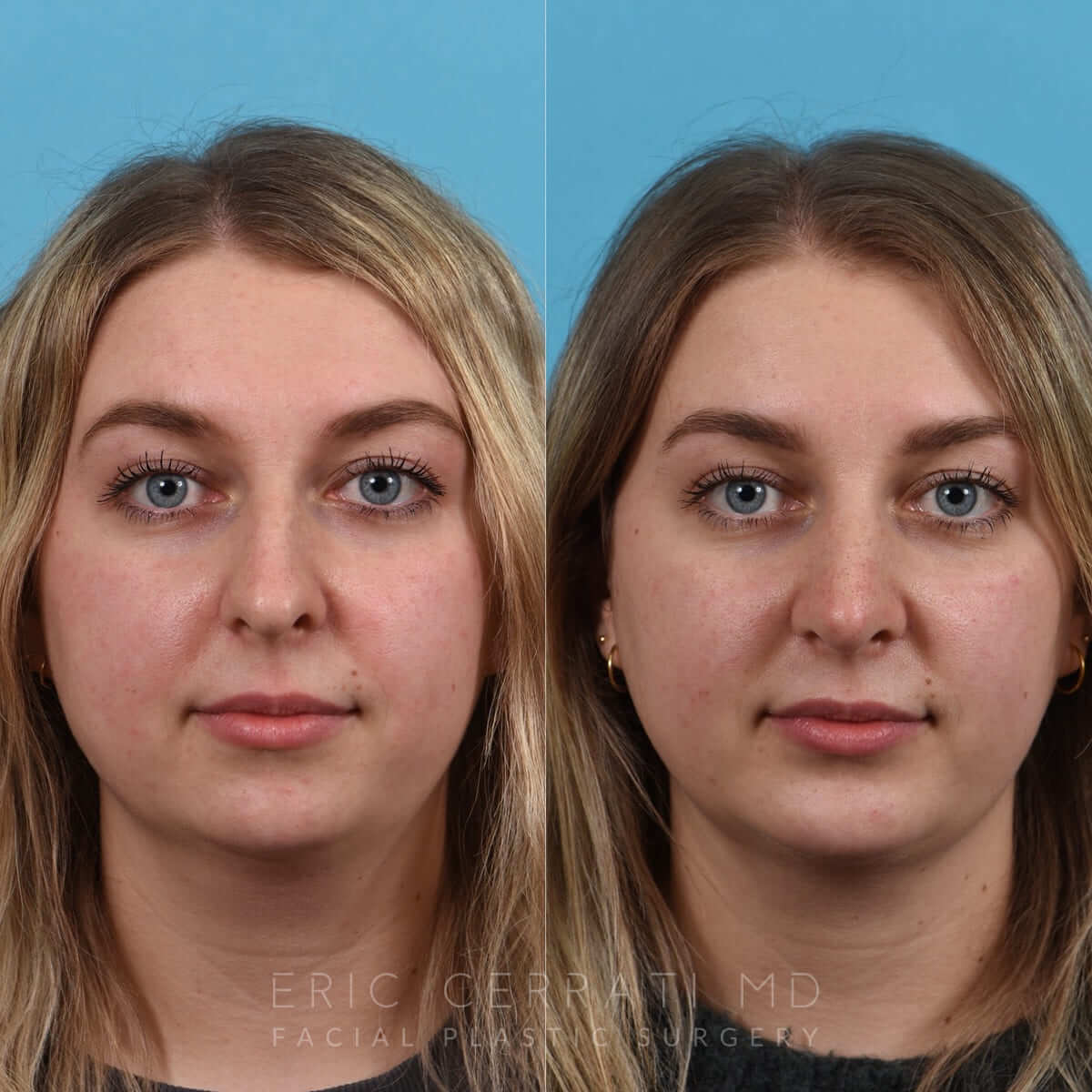 Rhinoplasty + Chin Implant before and after - before