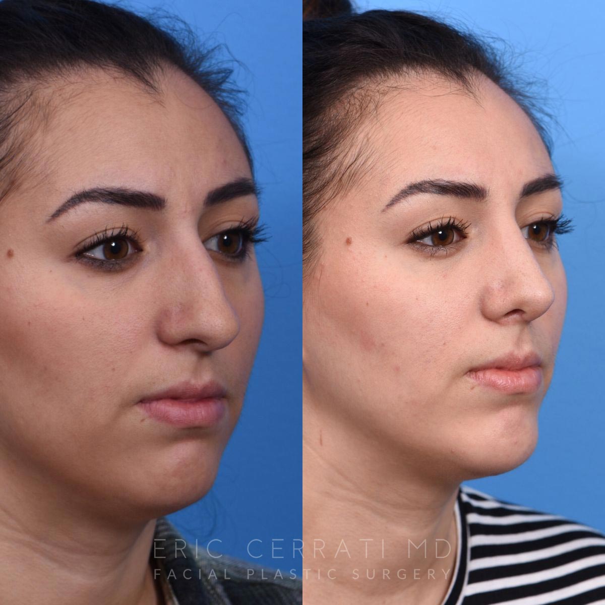 Facelift + Upper Blepharoplasty + Chin Implant before and after - after