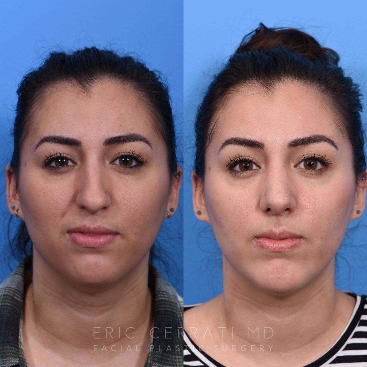Facelift + Upper Blepharoplasty + Chin Implant before and after - before