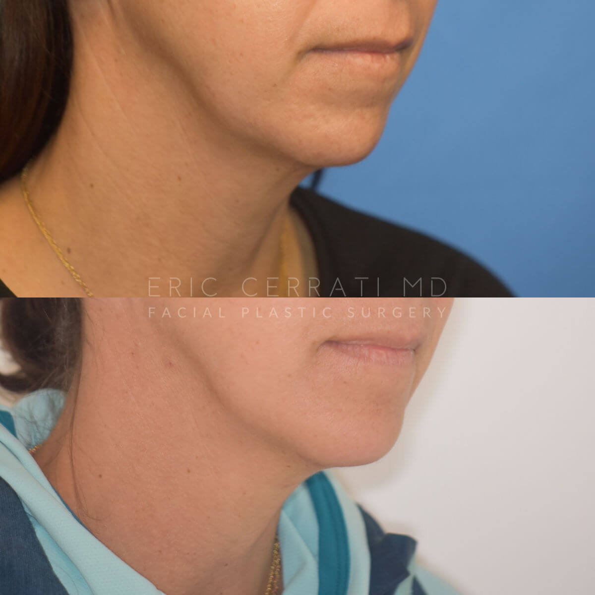 Chin Implant before and after - after