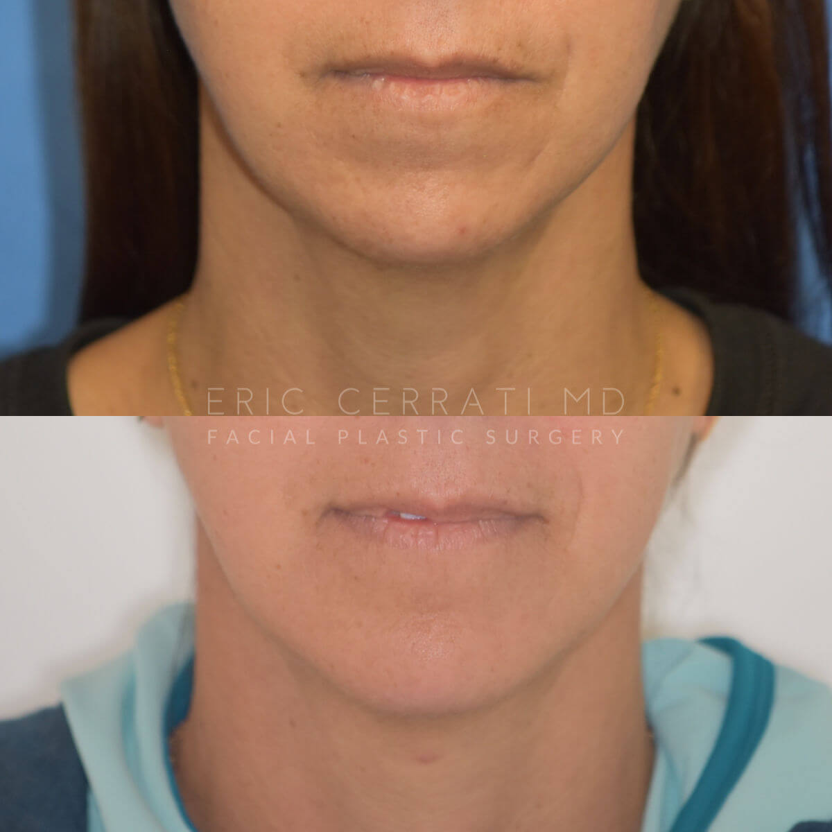 Chin Implant before and after - before