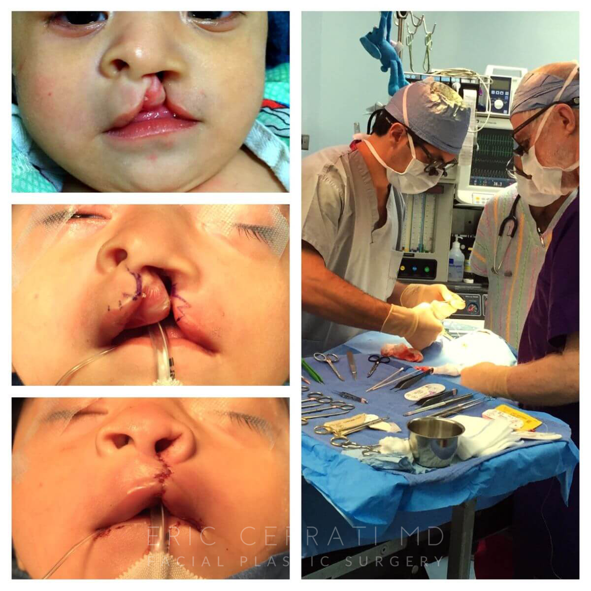 Cleft Lip and Palate Repair before and after - after