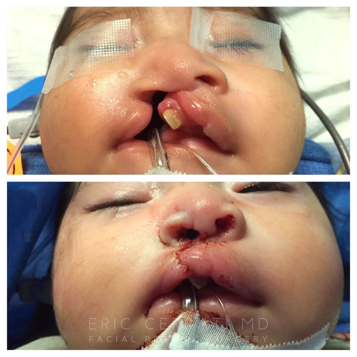 Cleft Lip and Palate Repair before and after - before