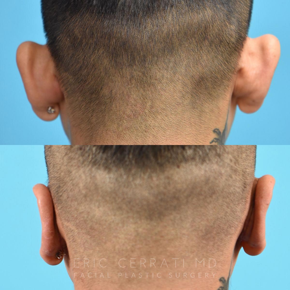 Rhinoplasty + Left Otoplasty before and after - after