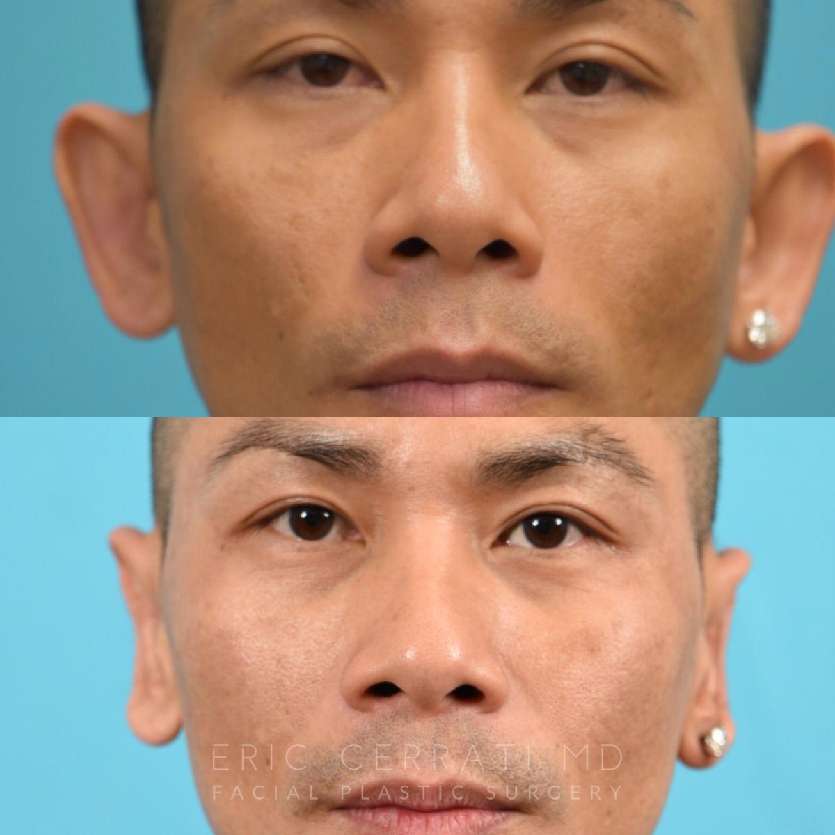 Rhinoplasty + Left Otoplasty before and after - before