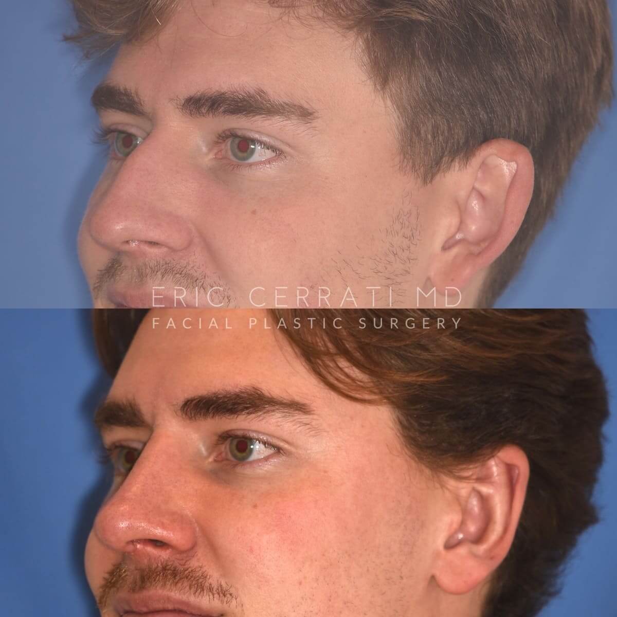 Rhinoplasty + Left Otoplasty before and after - after